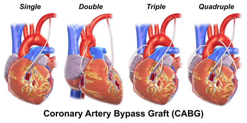 Coronary Artery Bypass Graft