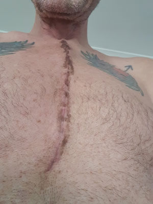 chest wound